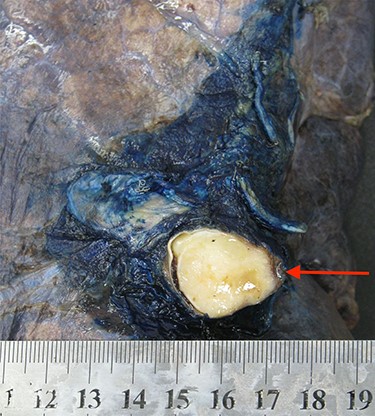 A cross-section image demonstrating the angiofibromatoid histiosarcoma obstructing the left main pulmonary artery.