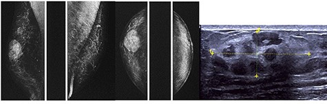 The diagnostic bilateral mammography in mediolateral oblique and craniocaudal views showed a well-circumscribed, oval, high density lesion in the right upper retroareolar region with no microcalcifications. Ultrasonography revealed a 36 mm-sized well-circumscribed mass of the right breast.