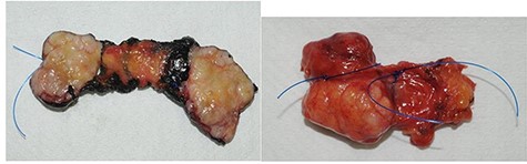 The macroscopic pathological examination showed a 36 mm-sized well-defined margins lesion