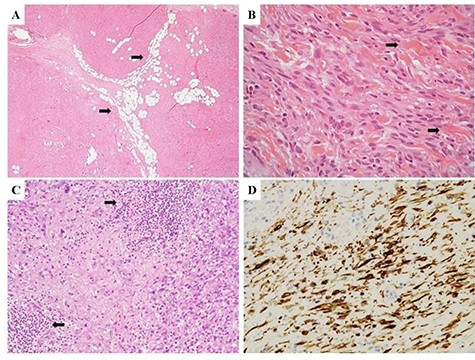 (A) Morphological features of Case 1, demonstrating a solid, cellular neoplasm with a fascicular growth pattern; interspersed, mature adipocytes were observed within the tumor stroma (arrows). (B) Neoplastic cells showed a spindled morphology with interspersed thick collagen bundles, a key diagnostic feature of MFB (arrows). (C) A densely collagenous stroma with interspersed lymphoid aggregates (arrows) was observed in some neoplastic areas. (D) Diffuse immunoreactivity for desmin confirmed the fibro-myofibroblastic lineage of neoplastic cells