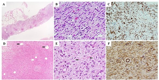 (A–C) Morphological and immunohistochemical features of the needle core biopsy demonstrating a solid, cellular neoplasm composed of spindle-shaped cells without cytological atypia nor mitotic activity (A and B). (C) Neoplastic cells demonstrated diffuse immunohistochemistry positivity for desmin, which, with the negative stainings for smooth muscle actin, CD34, S100 and pan-cytokeratins (AE1-AE3), was highly suggestive for myofibroblastic differentiation. On the basis of the above-mentioned findings, a descriptive pathological diagnosis of ‘myofibroblastic neoplasm without atypical features’ (B3) was rendered. (D) Morphological and imunohistochemical features of the surgically resected specimen demonstrating a cellular, bland-looking, spindle cell neoplasm with a minoritary adipocytic component (arrows). (E) Neoplastic cells showed a marked morphological variability characterized by spindled, oval and epithelioid shapes; interspersed collagen bundles were also observed within neoplastic stroma (arrows). (F) Diffuse immunoreactivity for desmin, consistent with fibro-myofibroblastic differentiation of neoplastic cells was observed