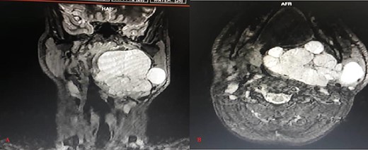 Magnetic resonance STIR WI imaging (A: Coronal, B: Axial) shows large, lobulated, well defined and hyper intense soft tissue lesion in the left para-pharyngeal space with the lesion extending from the skull base to the hyoid bone, significantly compromising the airways