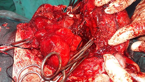 Intraoperative image shows that facial nerve branches around the tumor were dissected out past the mass, so that the tumor could be peeled away from the facial nerve.