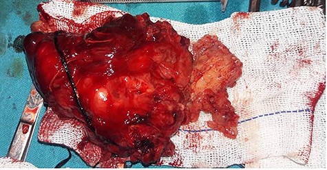 Gross feature of the mass Showing excised specimen of 16 × 10 × 4.5 cm in size