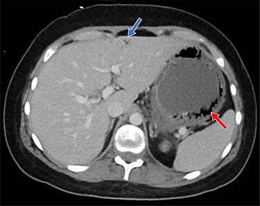 Shown is air in the gastric wall (red arrow) and air in the hepatic portal venous system (blue arrow)