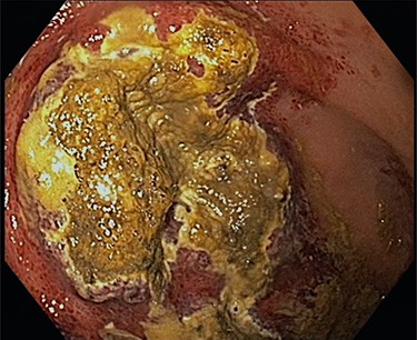 Shown is a large necrotic area in the gastric fundus and corpus along the greater curvature