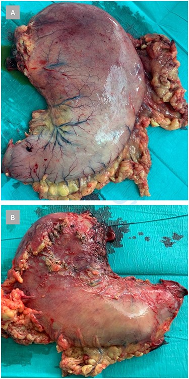 Shown is the resected stomach with extensive macroscopic signs of ischemic necrosis, primarily in the fundus and corpus. (A) Anterior view. (B) Posterior view