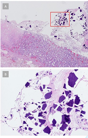 (A) Histopathology reveals signs of acute gastritis and ischemic tissue areas. Crystalline structures are found in the gastric tissue. (B) Gastric tissue crystals morphologically consistent with kayexalate crystals, suggesting SPS-related ischemic gastritis