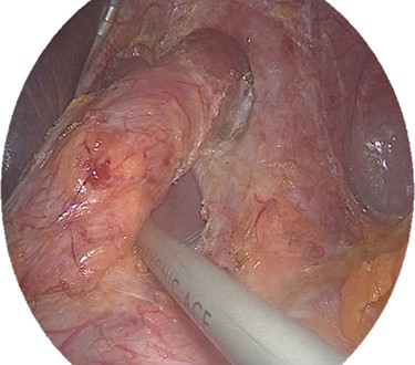 Dissected right crura (the esophagus is elevated by a clamp).