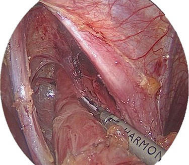 Mobilization of the intra-thoracal esophagus.