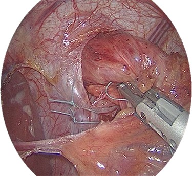 Posterior hiatoplasty (note that the vagal and arterial hepatic branches are preserved).