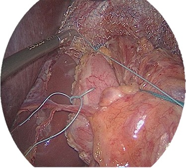 Fixation of the wrap (top fixation to the diaphragm, right and left fixation to the crus and the esophagus).