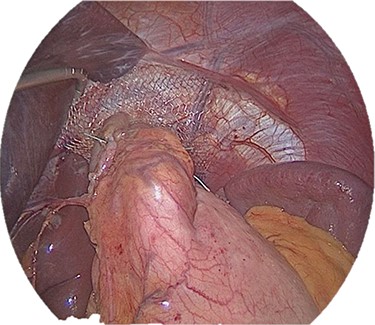 Tension free fundoplication with mesh.