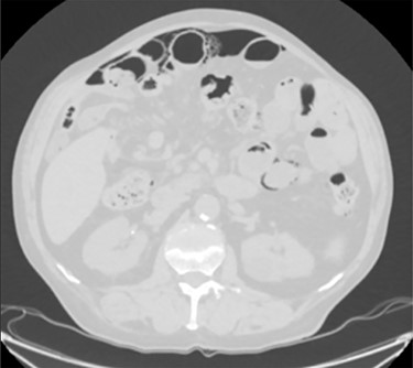 A moderate amount of intraperitoneal gas is present anteriorly to the small bowel.