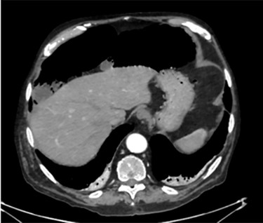 CT scan shows an apparently extensive pneumoperitoneum.