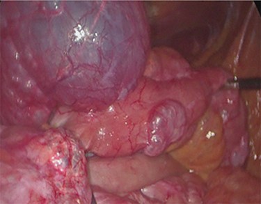 Intra-operatory findings of pneumatosis cystoides intestinalis of the small bowel.