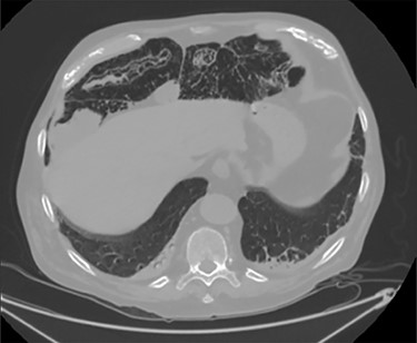PCI was ultimately identified retrospectively using lung window settings.