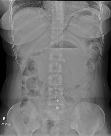 Anterior–posterior erect abdominal radiograph showing a large balloon seen in the middle of the abdomen with air/fluid level. No features of intestinal obstruction or perforation. No abnormal abdominal calcifications are noted.
