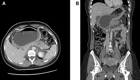 (A and B) Axial and coronal intravenous contrast-enhanced computed tomography images of the abdomen and pelvis showing an IGB compressing the pancreatic body with resultant pancreatic interstitial oedema and peri-pancreatic fluid collection.