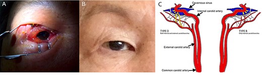 External photos of the patient’s eye before and after management of carotid-cavernous fistulas. (A) External photo of patient’s right eye upon presentation, prior to diagnosis of CCF. (B) External photos of patient’s eyes 6 months after resolution of CCFs. (C) Diagrammatic illustration of type D CCF on the right and type B CCF on the left as demonstrated by abnormal, yellow vasculature. Type D CCF on the right illustrates dural shunts between meningeal branches of both the internal and external carotid arteries and the cavernous sinus. Type B CCF illustrates dural shunts between meningeal branches of the internal carotid artery and cavernous sinus.