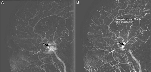 Diagnostic cerebral angiogram demonstrative of right indirect CCF. (A) Right ICA angiogram revealed indirect fistulization between the ECA branches and cavernous sinus (type D CCF) (B) with subsequent successful endovascular coil embolization.