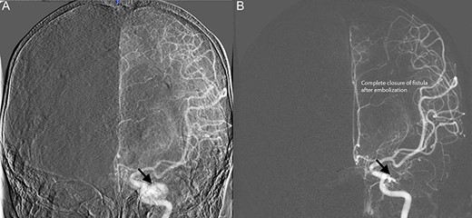 Diagnostic cerebral angiogram demonstrative of left indirect CCF. (A) Left ICA angiogram revealed a type B CCF supplied by branches of the meningohypophyseal trunk with inferior venous drainage (B) with evidence of subsequent spontaneous resolution.