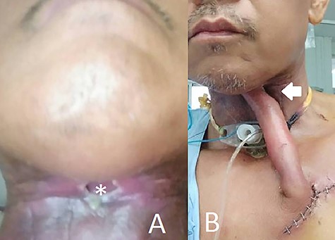 (A) Shows the preoperative fistula with a diameter of 2 cm and (B) shows the patient on the fifth day after the first surgery.