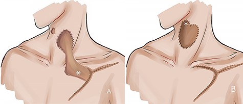 (A) Shows a schematic illustration of the first stage of the revision operation. The shortened deltopectoral flap was placed at a temporary recipient site. (B) Shows a schematic illustration of the second stage of the revision operation.