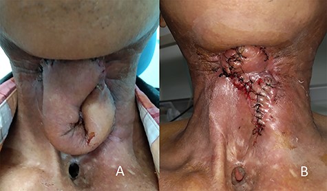 (A) Shows the patient at 6 weeks after the second stage of the revision operation, at which point the fistula was completely sealed; (B) shows the patient after the third stage of the revision operation.