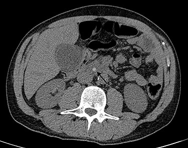 Computed tomography scan image showing stone in CBD.