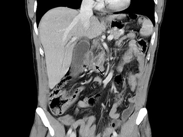 Computed tomography scan image showing stone in CBD.