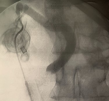 Trans-cystic cholangiography demonstrating prepapillary lithiasis.
