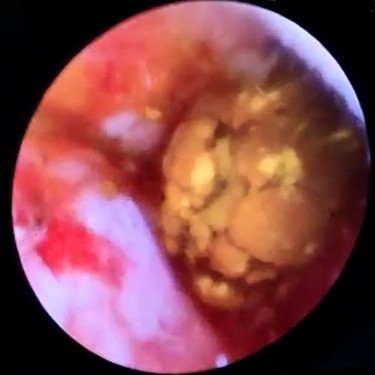 Choledochoscopic vision of CBD-retained stone.