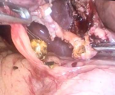 Trans-cystic stone extraction with Dormia basket.