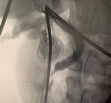 Postprocedure cholangiography.
