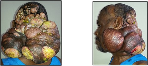 Posterior and left lateral clinical photographs of the recurrent malignant GCT.