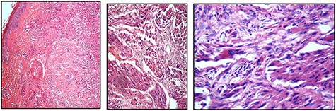(A, B, and C) Showing the evidence of cellular spindling, hyperchromasia and nuclear pleomorphism, features in keeping with malignant GCT, ranging from low to high magnifications, respectively