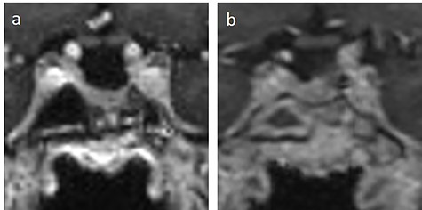 (a) preoperative and (b) post-operative MRI T1-weighted coronal image with contrast medium of the sella.