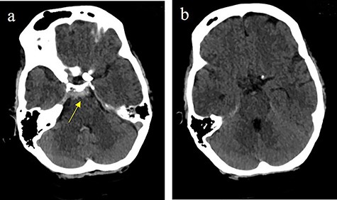 Subarachnoidal bleeding into the basal cistern-axial cranial computed tomography (cCT) at the level of (a) prepontine cistern (arrow) and (b) pentagonal cistern.