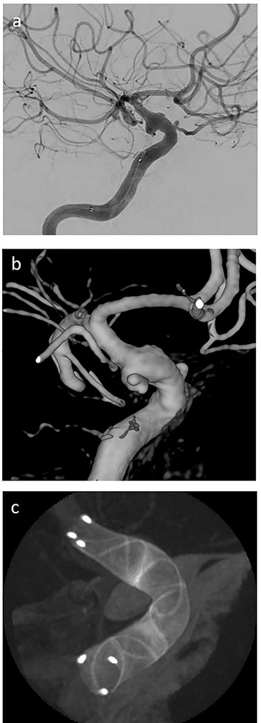 (a) lateral angiogram of left carotid artery showing an ICA aneurysm; (b) 3D reconstruction of the pseudoaneurysm with (c) flow diverter (Derivo®—4,5/20) reconstruction.