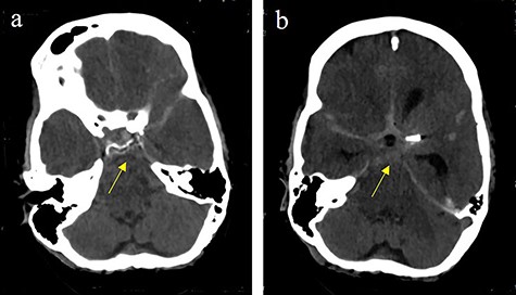 Massive progress of SAH axial cCT at the level of (a) prepontine cistern (arrow) and (b) pentagonal cistern (arrow)