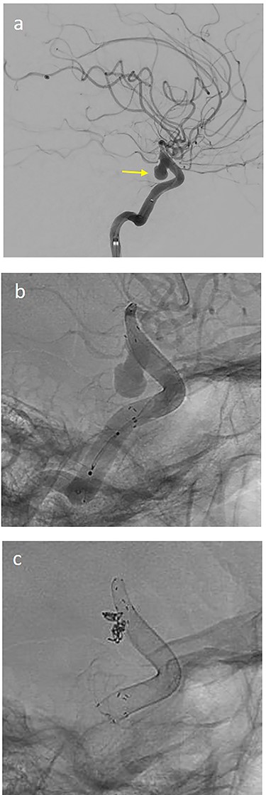 (a) lateral angiogram of left carotid artery showing ICA aneurysm before the second endovascular treatment; (b) Lateral view after implantation of two additional flow diverters (2× Derivo®—4,5/20); (c) Lateral view after additional coil embolization (HydroSoft™ 2/3 and 2× 1,5/2).