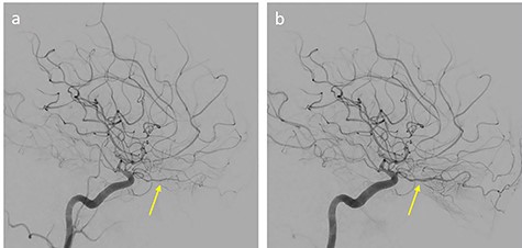 Anteroposterior left carotid artery angiograms; (a) during vasospasm (arrow) and (b) after intraarterial 2 mg nimodipin administration (arrow)