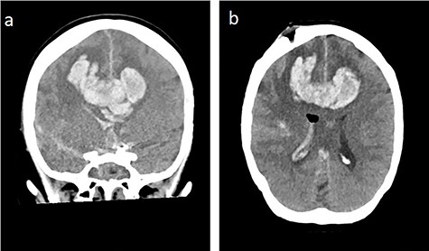 Bifrontal intracerebral bleeding with brain swelling and herniation: (a) coronal cCT, (b) axial cCT