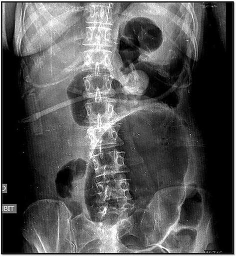 Image of the volvulus in the abdominal X-rays.