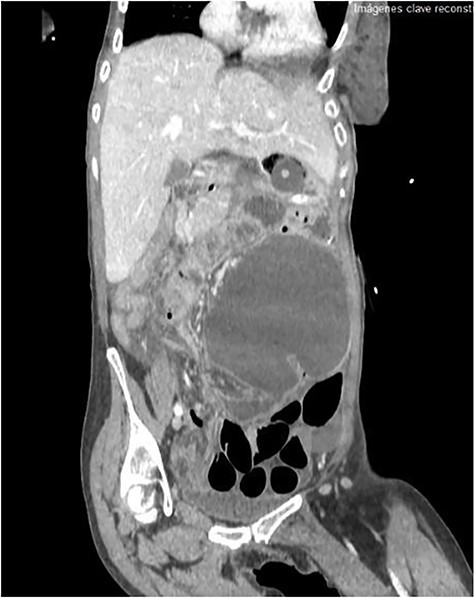 Sagital plane of cecum volvulus on CT scan.