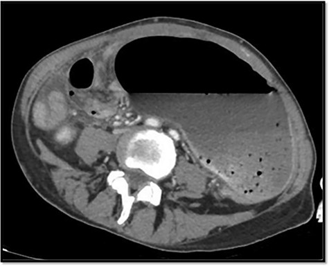 Axial plane of cecum volvulus on CT scan.