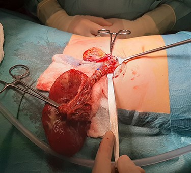 Intraoperative view of an omental torsion owing to a lipoblastoma of the greater omentum.