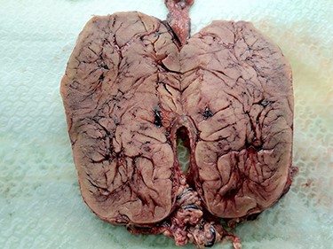 Close-up view of the macroscopic appearance of internal structure of the omental lipoblastoma.