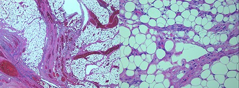 Microscopic images of the omental lipoblastoma taken through a 2.5X (left) and 20X (right) objectives on hematoxylin and eosin-stained histological sections.